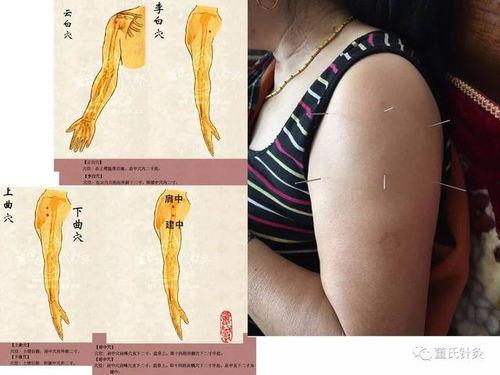 董氏针视频,揭秘传统针灸精髓